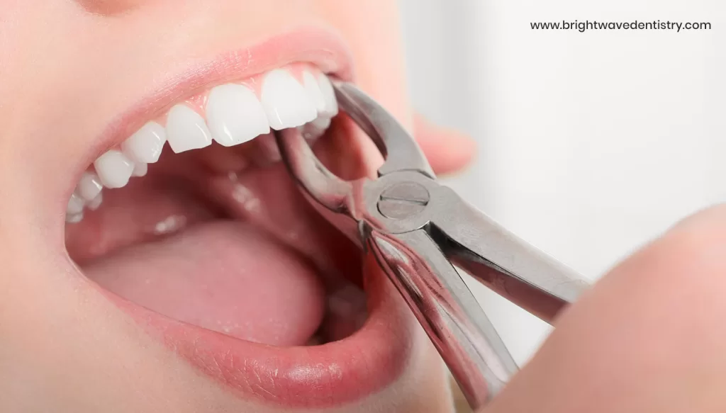 Tooth extraction Las Vegas