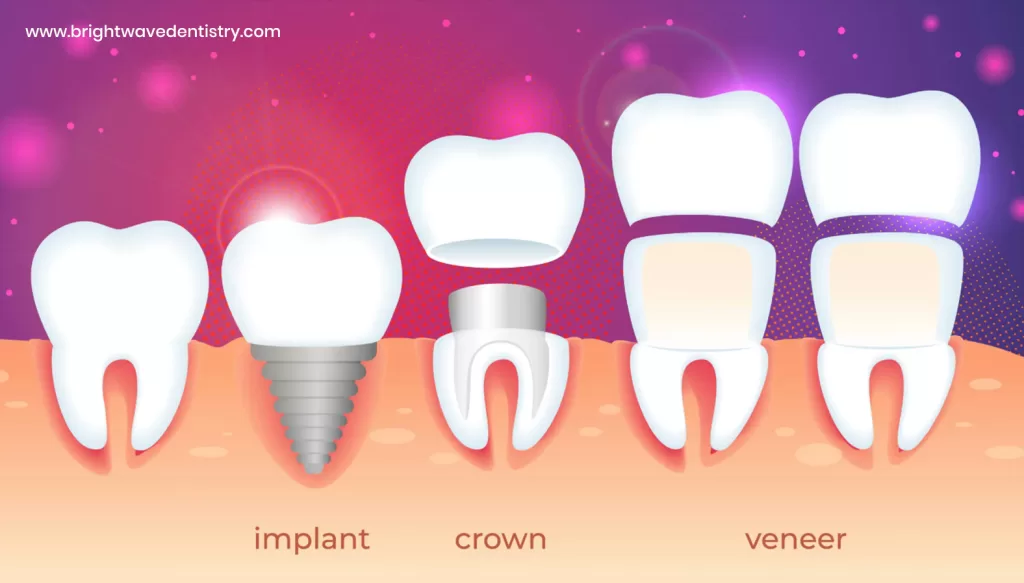 How much are veneers in Las Vegas