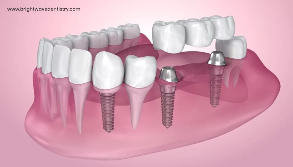 How much is a full set of dental implants